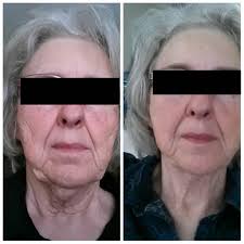 Facial Rejuvination Before and After
