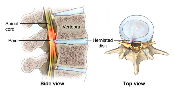 herniated disc diagram