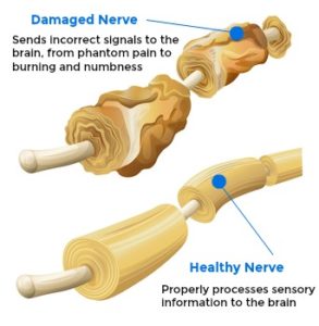 Neuropathy Treatment | Charlotte, NC | Select Health