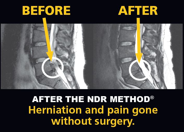 MRI image of disc herniation before and after NDR Method treatment