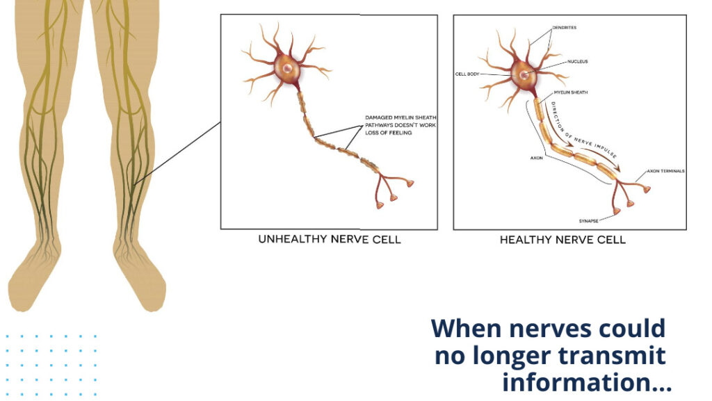 Neuropathy and nerve damage