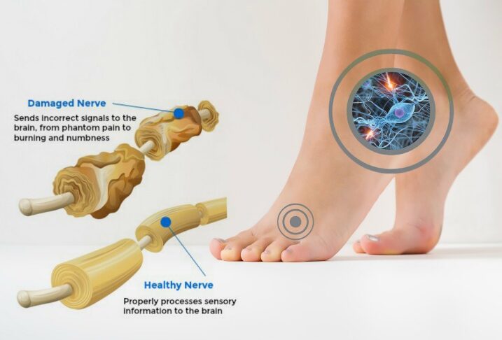 Neuropathy of the Feet