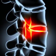 herniated lumbar disc illustration