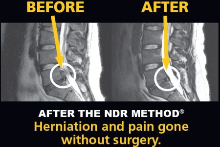 https://selecthealthofthecarolinas.com/wp-content/uploads/elementor/thumbs/MRI-Lumbar-Spine-Before-After-the-NDR-Method-q36k832xl5c9nygum4daw9fptipat05o8amvzaabso.jpg